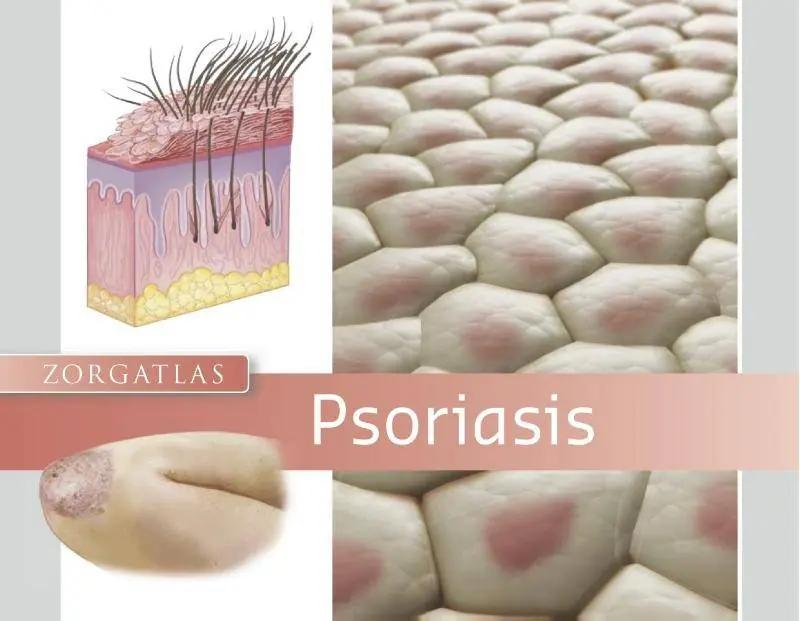 Speciale Aanbieding Psoriasis / Druk 1