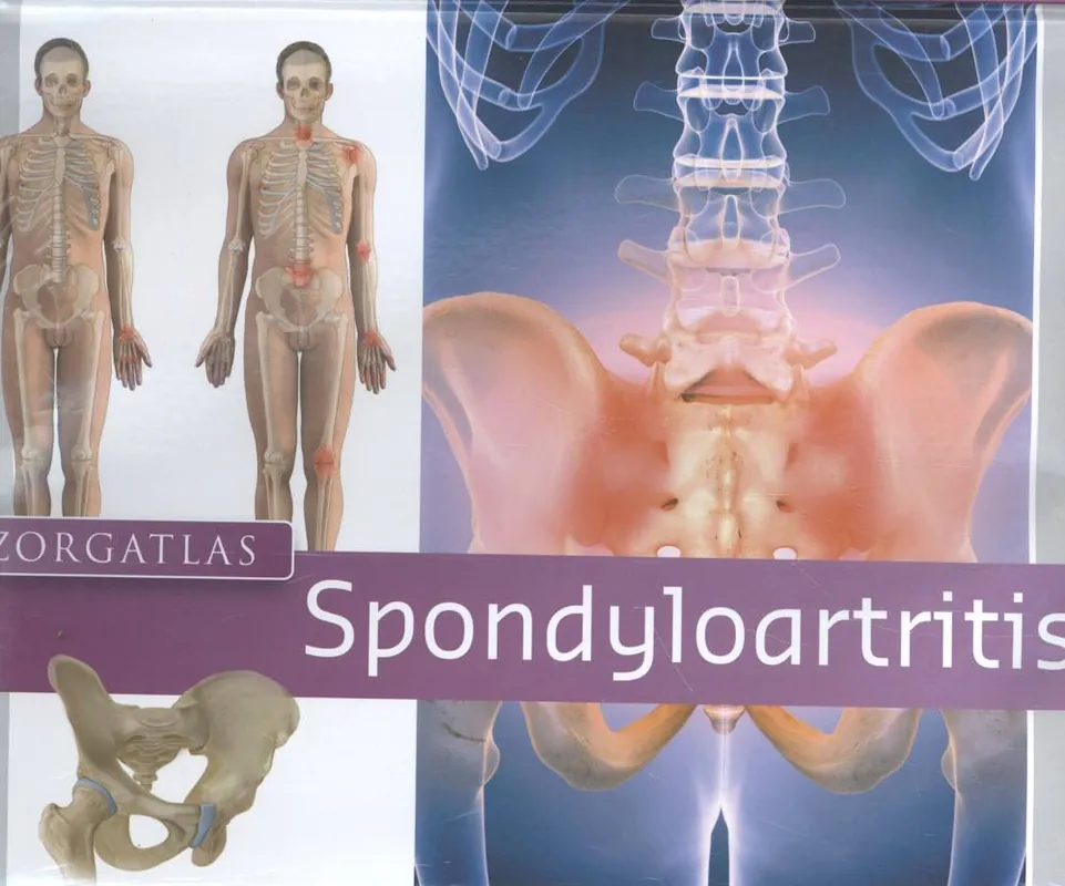 Zorgatlas Spondyloartritis / Druk 1 Populair