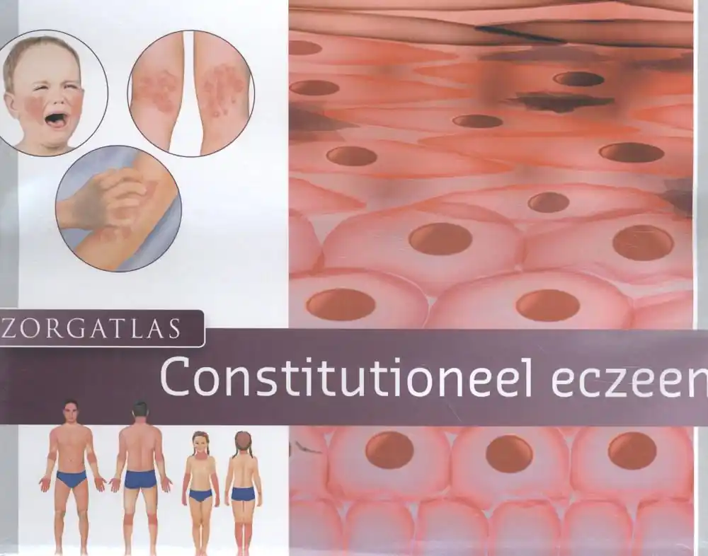 Beperkt Aanbod Zorgatlas constitutioneel eczeem / Druk 1